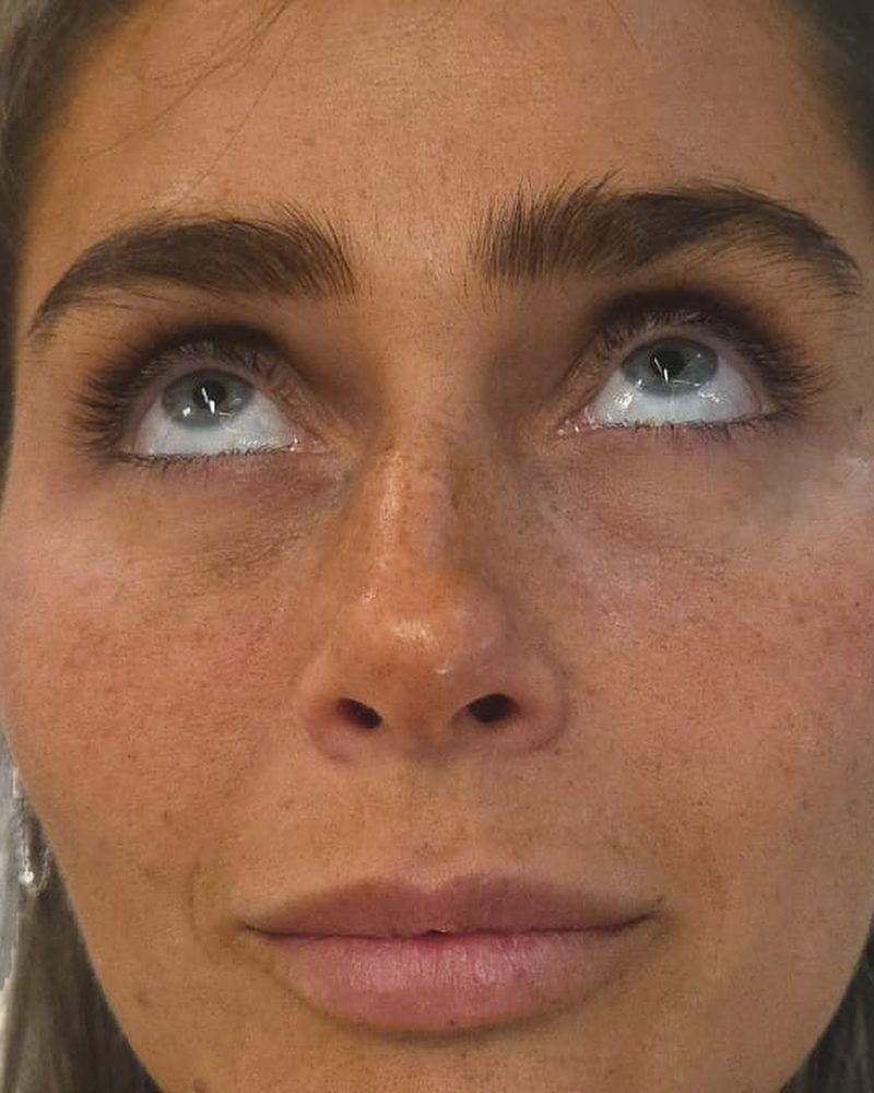 אזור שקעי העיניים אחרי הטיפול
