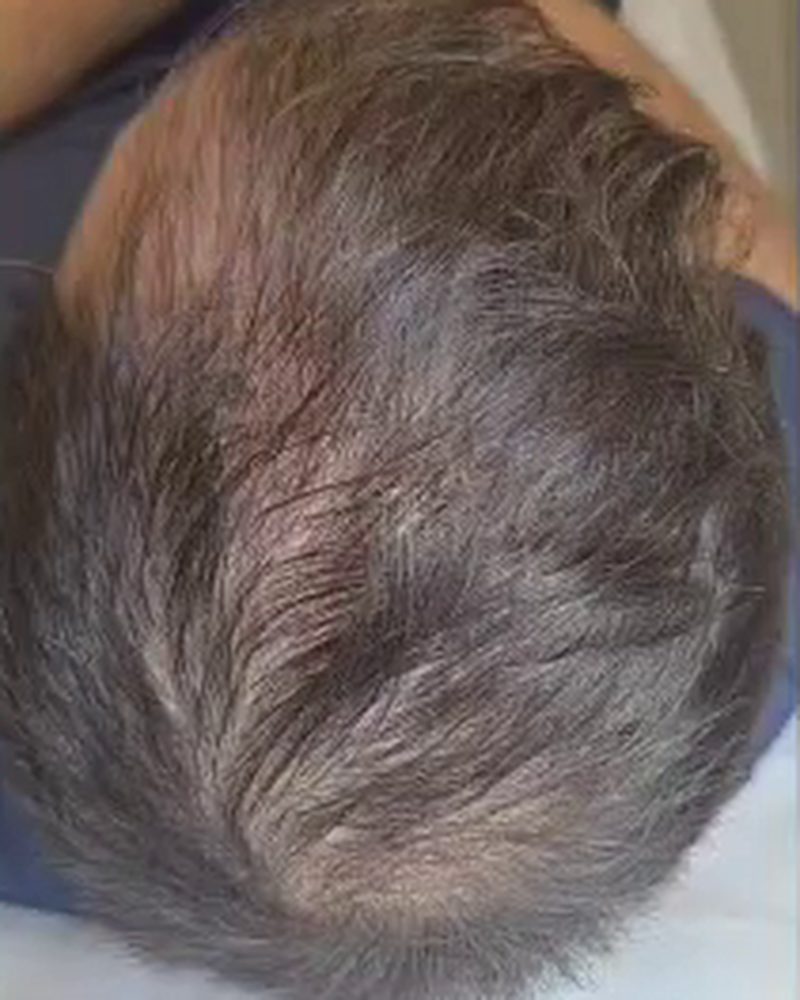 שיער דליל בקודקוד, לפני הטיפול